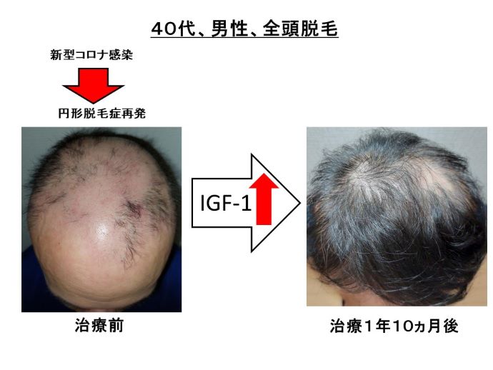 円形脱毛症　病院